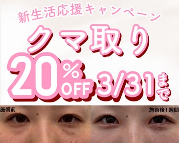 【SBC水戸院】クマ取り20％OFFキャンペーン開催中✨クマ取りするなら湘南美容クリニック水戸院へ🩵